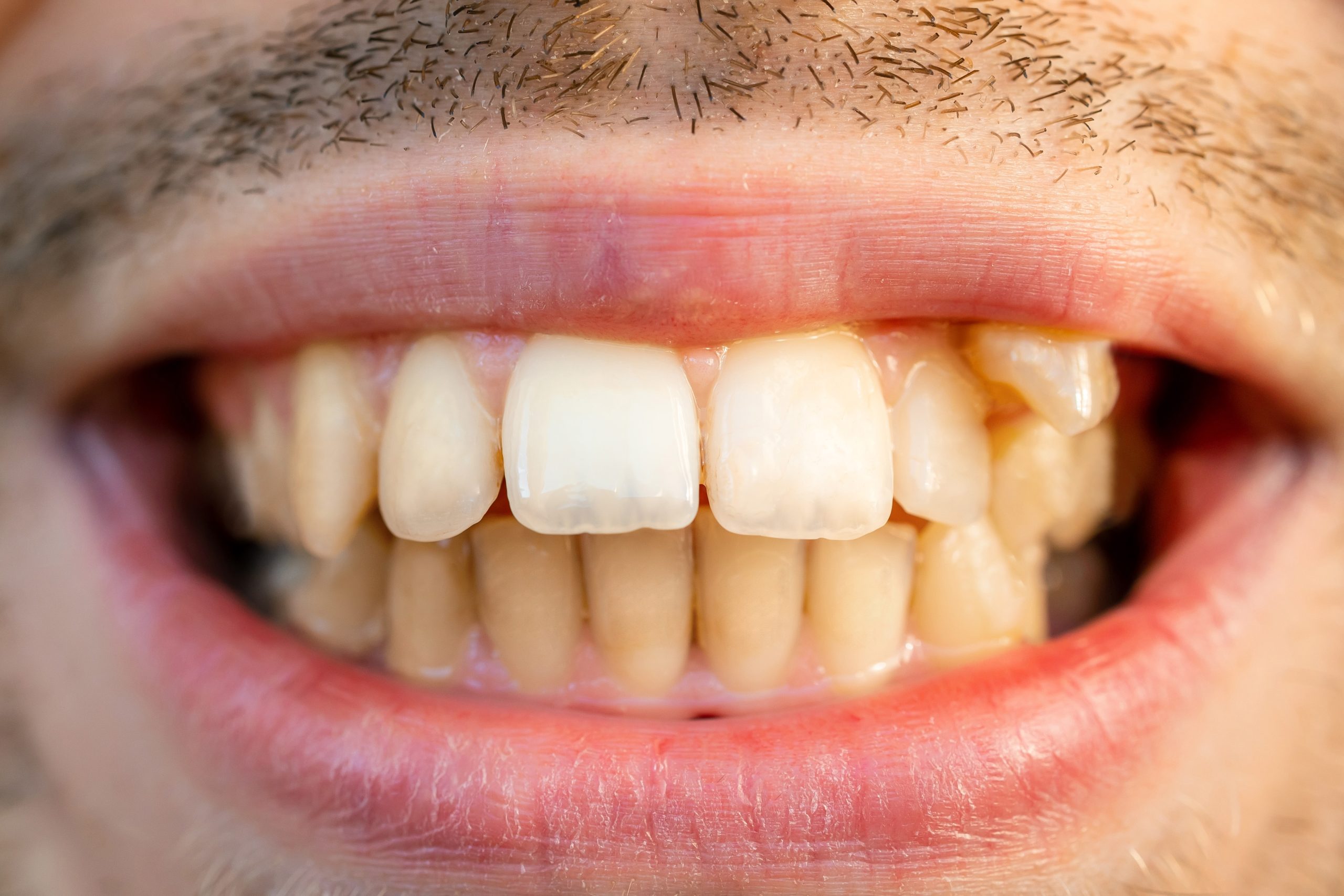 Close up of man’s face with crooked teeth before install braces. Teeth need ortodontic treatment. Close up of man's face with crooked teeth before install braces. Teeth need ortodontic treatment.