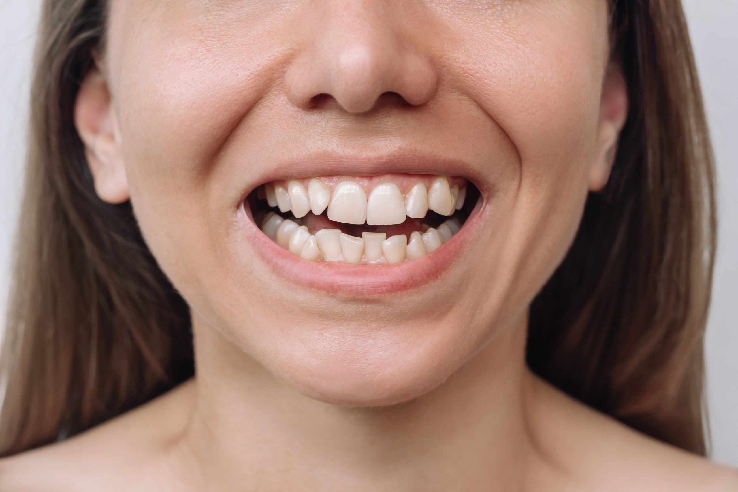 Cropped shot of a young caucasian woman demonstrating ragged teeth on a white background. Dental health care. Dentistry. Female uneven teeth Cropped shot of a young caucasian woman demonstrating ragged teeth on a white background. Dental health care. Dentistry. Female uneven teeth